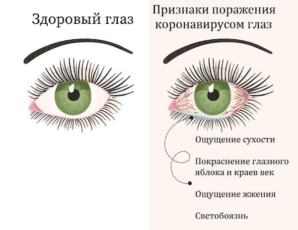 Глаз, пораженный коронавирусом