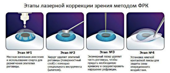 Проведение лазерной коррекции