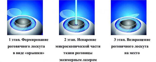 Схема лазерной коррекции Ласик