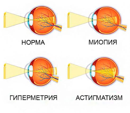 Патологии зрения