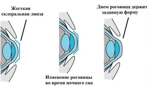 Жесткие контактные линзы