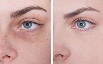 До и после массажа глаз