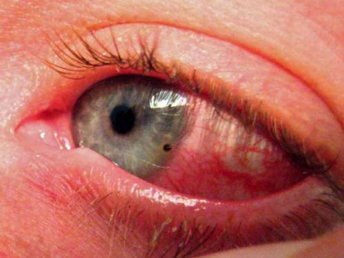 Ожог глаза – причины, симптомы и лечение повреждения роговицы глаза | «Будь Здоров»
