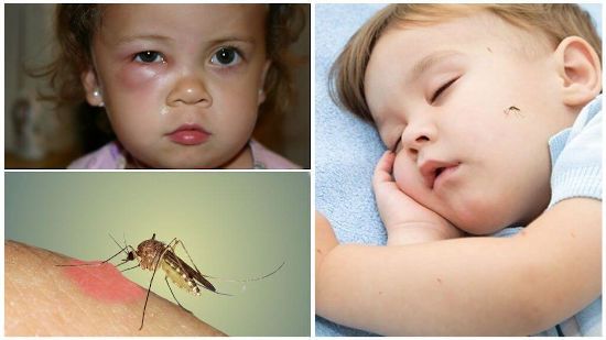 Комар на лице ребенка