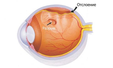 Отслоение сетчатки