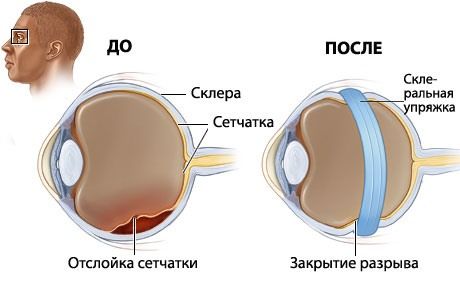 Отслоение сетчатки