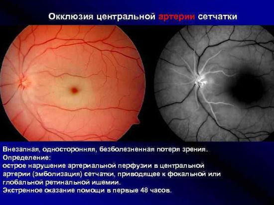 Окклюзия центральной артерии сетчатки