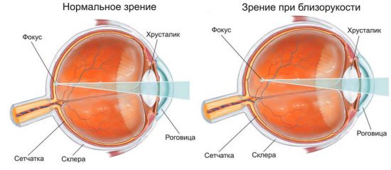 Зрение при близорукости