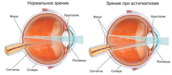 Зрение при астигматизме