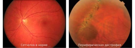 Офтальмоскопия сетчатки