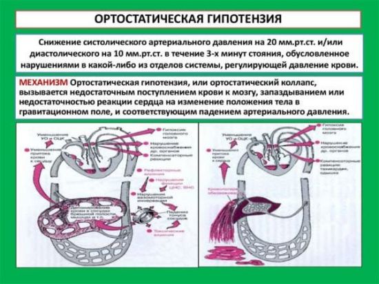 Описание ортостатической гипотензии