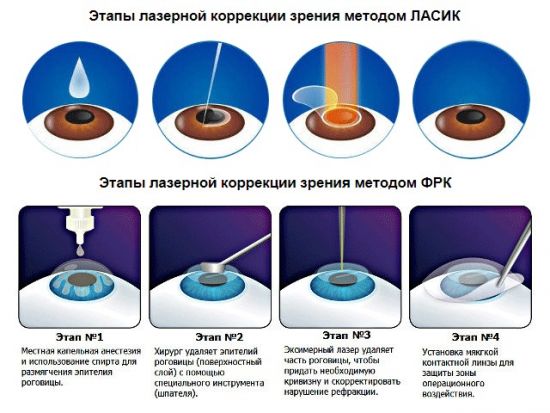 Лазерная коррекция зрения