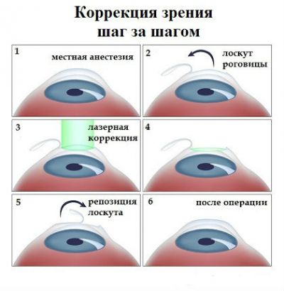 Лазерная коррекция зрения