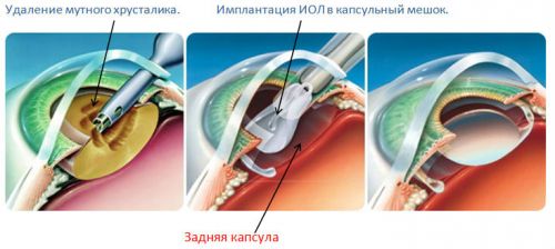 Операция при катаракте