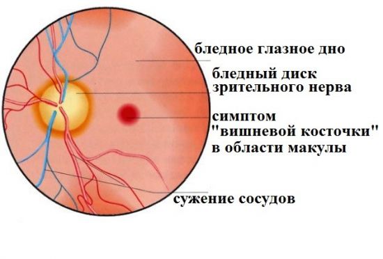 Тромбоз центральной артерии сетчатки