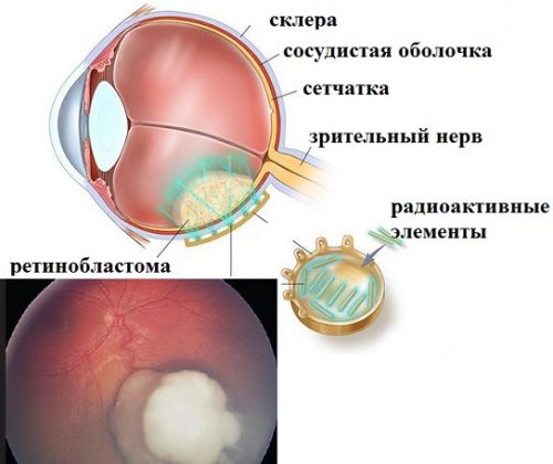 Лучевая терапия рака сетчатки