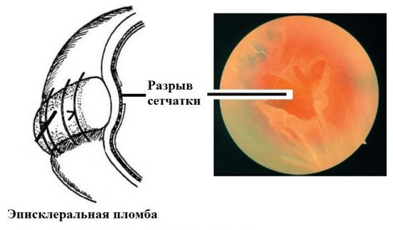 Предупреждение отслойки сетчатки