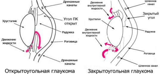 Глаукома