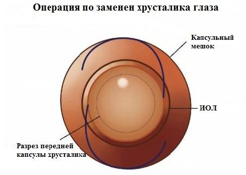 Замена хрусталика