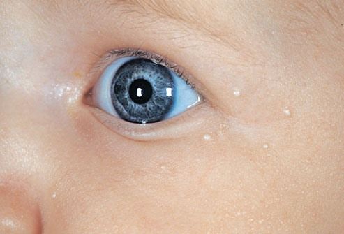 Миллиумы вокруг глаз у ребенка