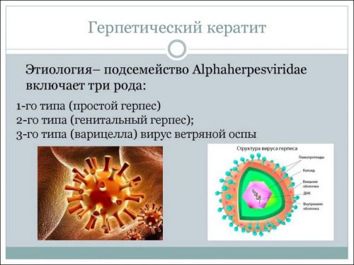 Герпетический кератит