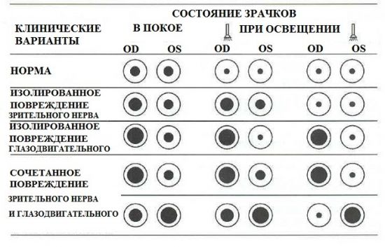 Нарушение зрачкового рефлекса