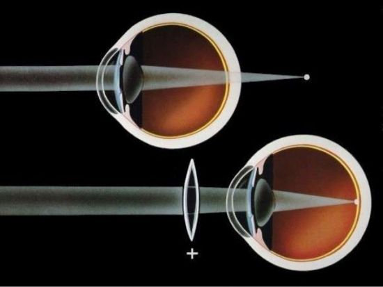 Коррекция дальнозоркости