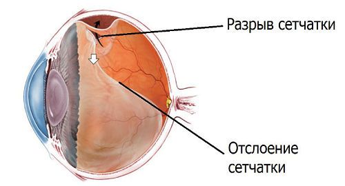 Отслойка сетчатки глаза