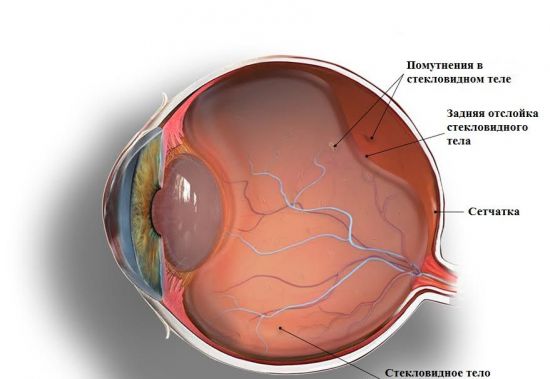 Отслоение стекловидного тела