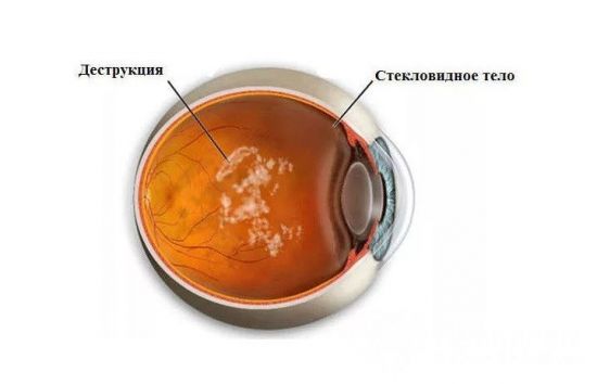 Деструкция стекловидного тела