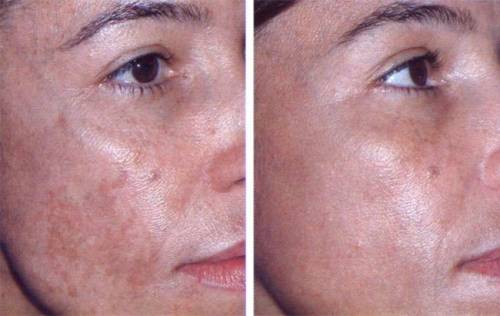 Кожа лица до и после лечения
