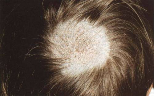 Микроспория кожи головы