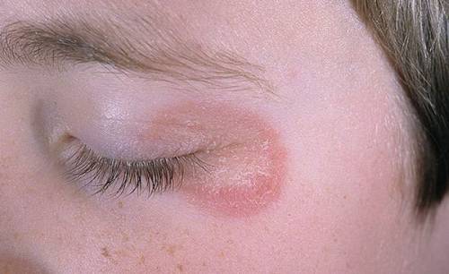 Грибковая инфекция на лице