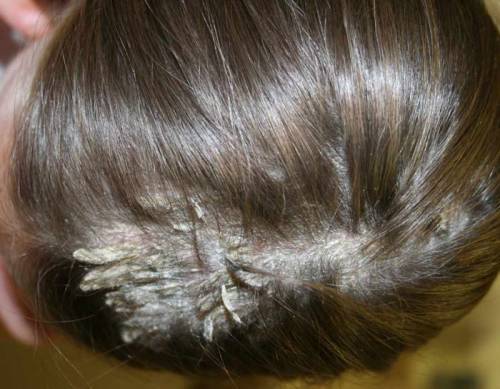 Кератоз волосистой части головы