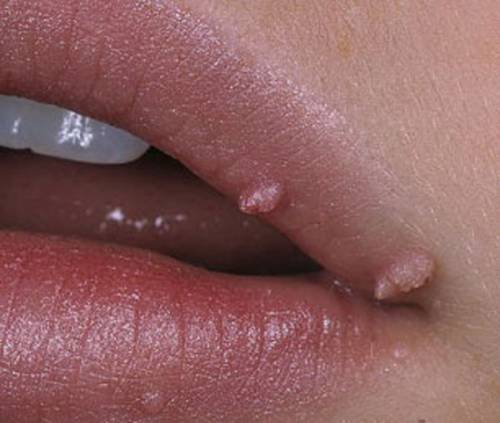 Папилломы на губах