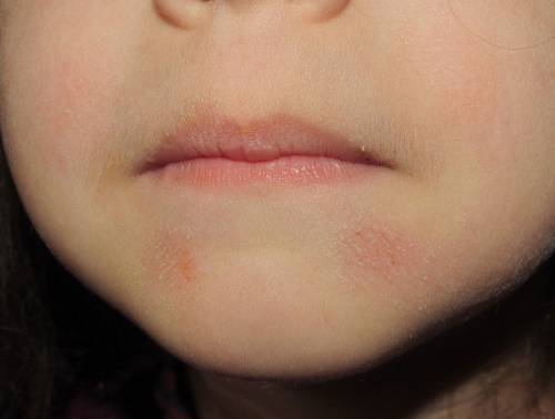 Шелушение кожи вокруг губ