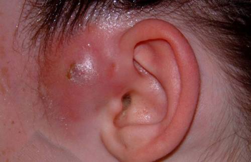 Воспаление около уха