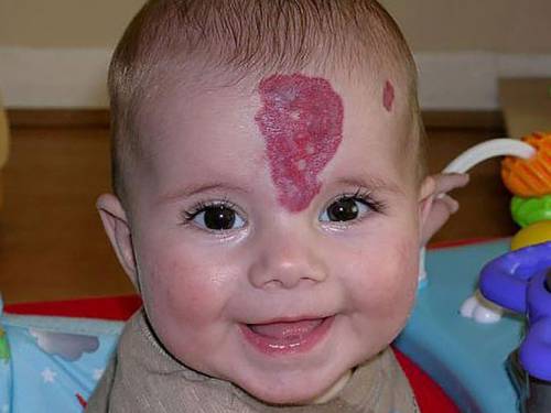 Родимое пятно на лице у ребенка