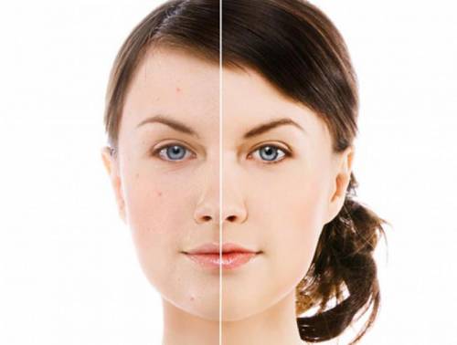 Лицо до и после использования средств для проблемной кожи