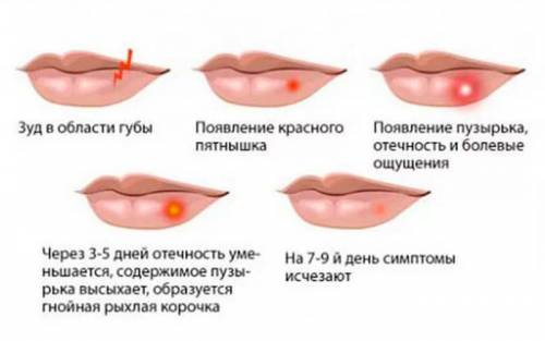 Этапы появления герпеса на губе