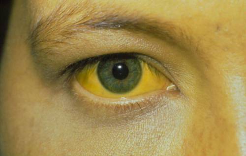 Желтизна глазных склер